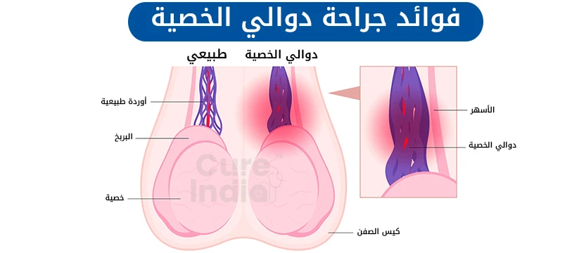 فوائد جراحة دوالي الخصية في الهند
